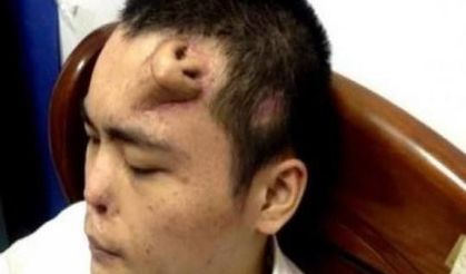 Alnında burun çıktı