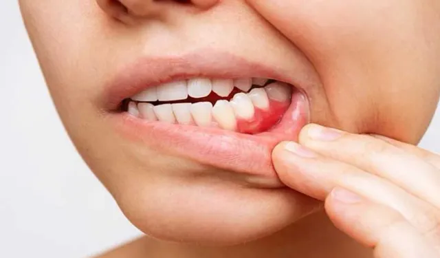 Diş Eti Çekilmesi: Nedenleri, Belirtileri ve Tedavi Yöntemleri